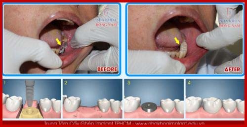 Cấy ghép Implant phục hồi răng hàm bị mất