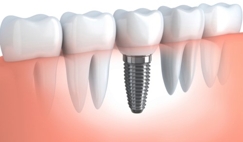 Mất răng hàm cấy ghép implant phục hồi được không