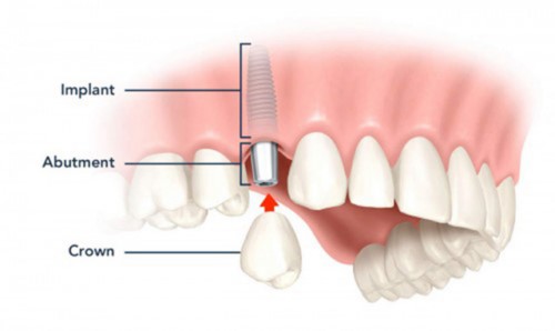 Trồng răng giả bằng kỹ thuật cấy ghép Implant