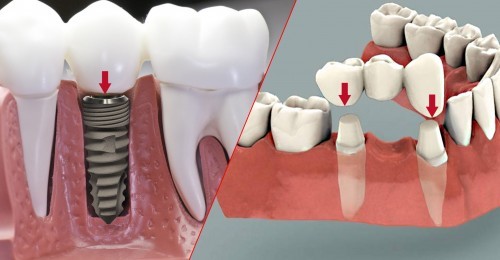 (Răng Implant có nhiều ưu điểm vượt trội hơn so với răng sứ)