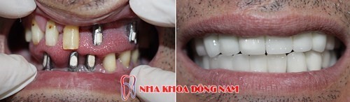 (Cấy ghép Implant mang lại tính thẩm mỹ và chức năng giống hệt như răng thật)