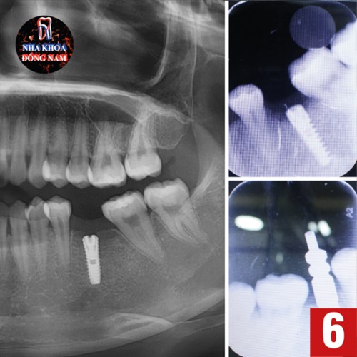 Nha Khoa Đông Nam rất chu đáo và nhiệt tình chuyên sâu về Trồng Răng Implant
