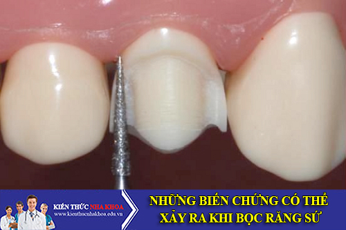 những biến chứng có thể xãy ra khi bọc răng sứ
