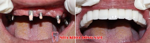 những lợi ích khi trồng răng implant mà các bạn nên biết 1