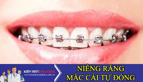 niềng răng mắc cài tự đóng