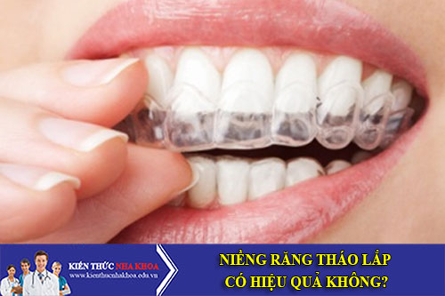 niềng răng tháo lắp có hiệu quả không