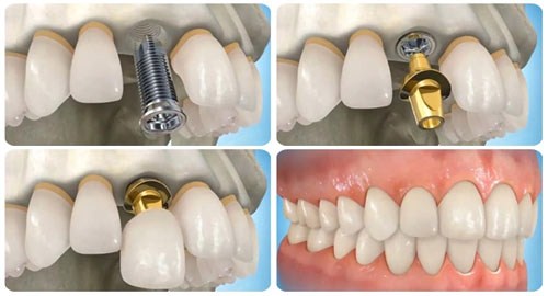 phương pháp phục hình răng tháo lắp có tốt không 6