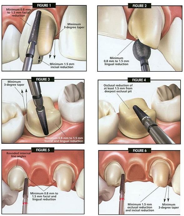 quy trình làm cầu răng sứ