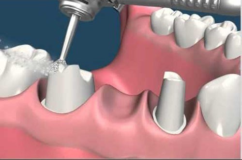 sự giống và khác nhau của răng tháo lắp và răng cố định 2