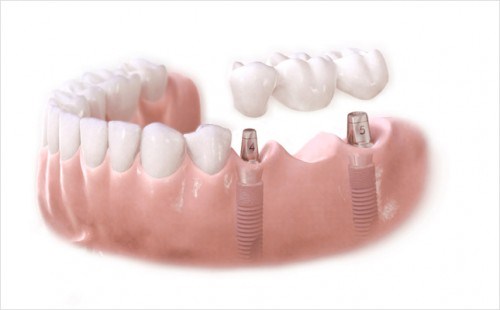sự giống và khác nhau của răng tháo lắp và răng cố định 5