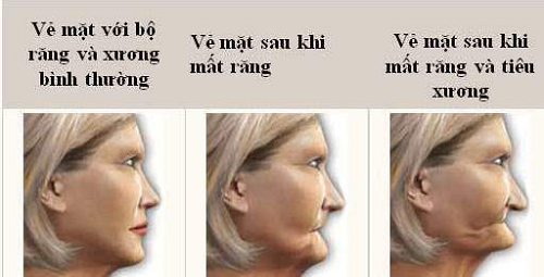 mất răng lâu gây tiêu xương hàm