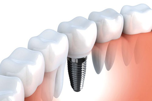 tổng quan cấy ghép implant