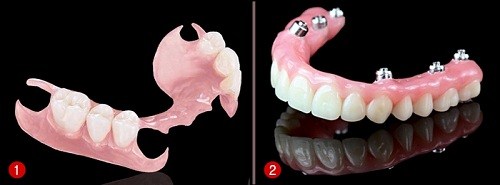 tổng quan về phương pháp răng tháo lắp 3
