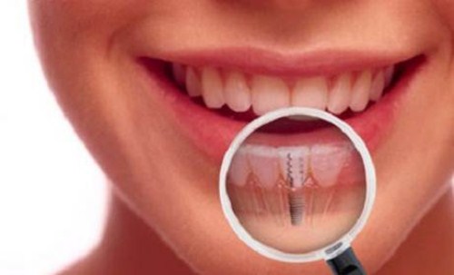 tổng quan về phương pháp trồng răng implant 3