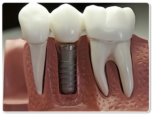tổng quan về phương pháp trồng răng implant 6