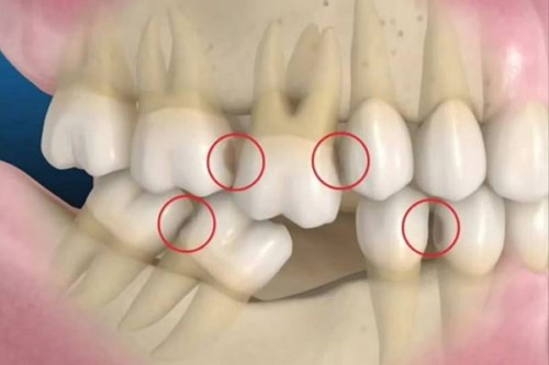 Trồng Implant Khi Bị Mất 1 Răng Có Được Không?