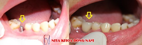 Trồng Implant Khi Bị Mất 1 Răng Có Được Không?