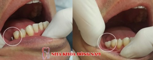 Trồng Implant Khi Bị Mất 1 Răng Có Được Không?