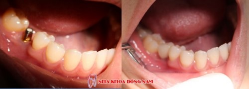 Trồng Implant Khi Bị Mất 1 Răng Có Được Không?