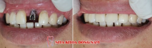 Trồng Implant Khi Bị Mất 1 Răng Có Được Không?