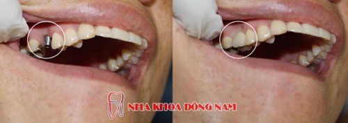 Trồng Implant Khi Bị Mất 1 Răng Có Được Không?