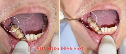 Trồng Implant Khi Bị Mất 1 Răng Có Được Không?