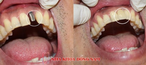 Trồng Implant Khi Bị Mất 1 Răng Có Được Không?