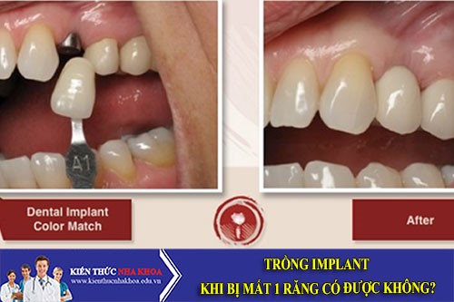 Trồng Implant Khi Bị Mất 1 Răng Có Được Không?