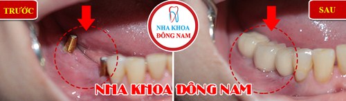 Trồng răng giả nguyên hàm loại nào tốt và tiết kiệm nhất 3