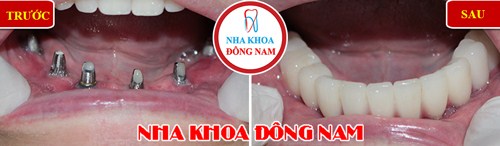 Trồng răng giả nguyên hàm loại nào tốt và tiết kiệm nhất 4