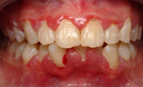 viêm nướu răng có nguy hiểm không 2