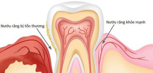 viêm nướu răng có nguy hiểm không 6