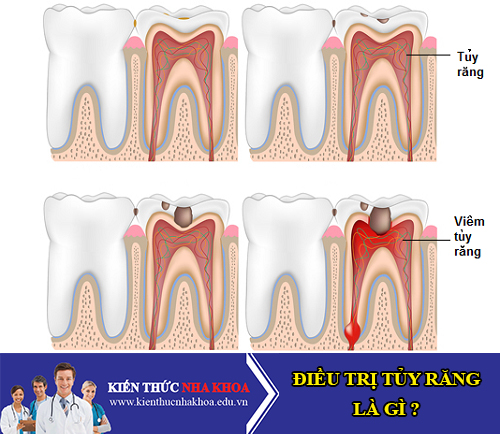 Điều Trị Tủy Răng Là Gì?