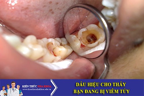 Dấu Hiệu Cho Thấy Bạn Đang Bị Viêm Tủy