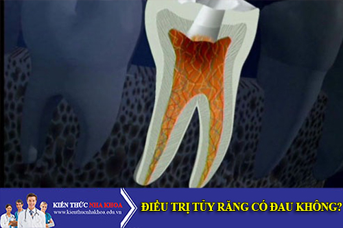 Điều Trị Tủy Răng Có Đau Không?