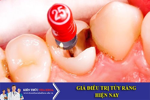 Giá Điều Trị Tủy Răng Hiện Nay