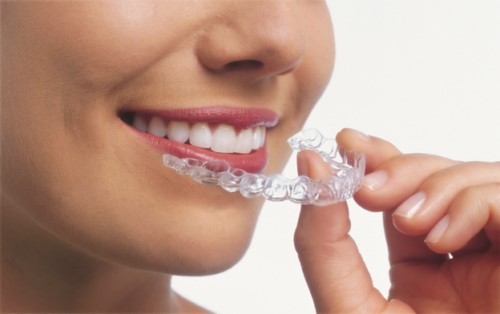 Máng chống nghiến răng – Giải pháp điều trị nghiến răng hiệu quả