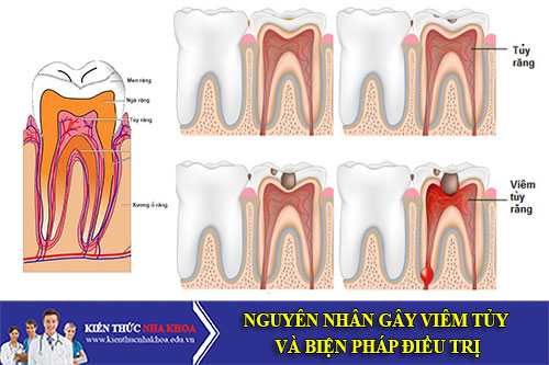 Nguyên Nhân Gây Viêm Tủy Và Biện Pháp Điều Trị