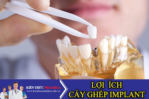 Những Lợi Ích Của Việc Cấy Ghép Răng Implant