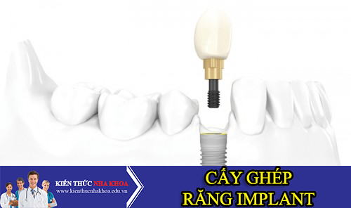 Tổng Quan Về Cấy Ghép Răng Implant