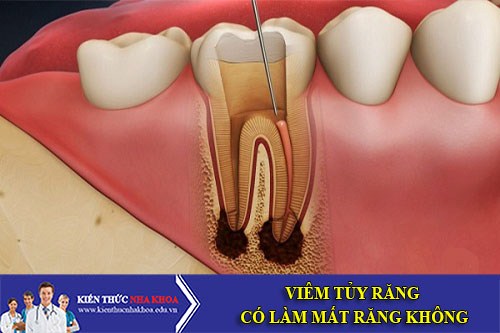 Viêm Tủy Răng Có Làm Mất Răng Không?