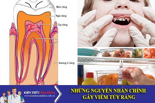 Những Nguyên Nhân Chính Gây Viêm Tủy Răng